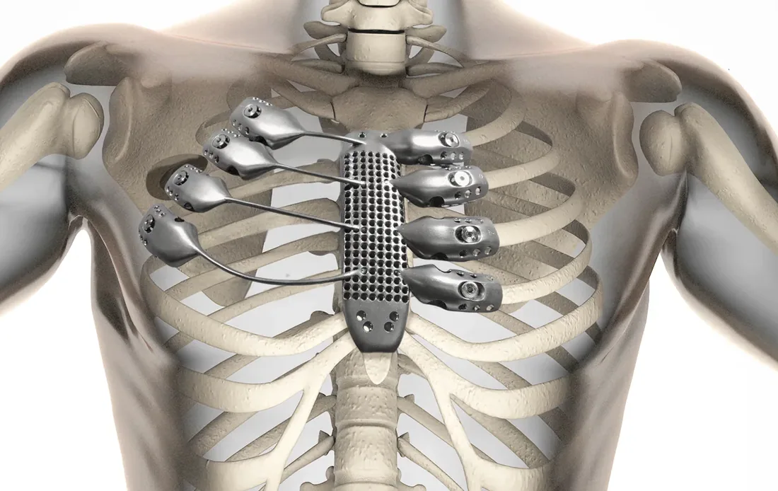 3D-Printtechnologie in de Zorg
