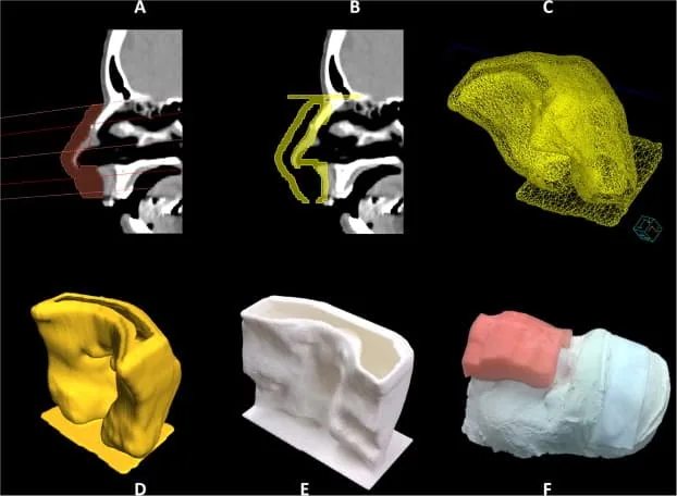 3D-Printtechnologie in de Zorg